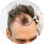 Painless Hair Transplant in jaipur|cosmo care