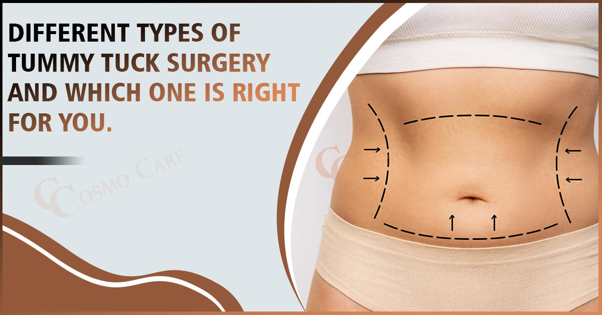 Tummy Tuck Surgery