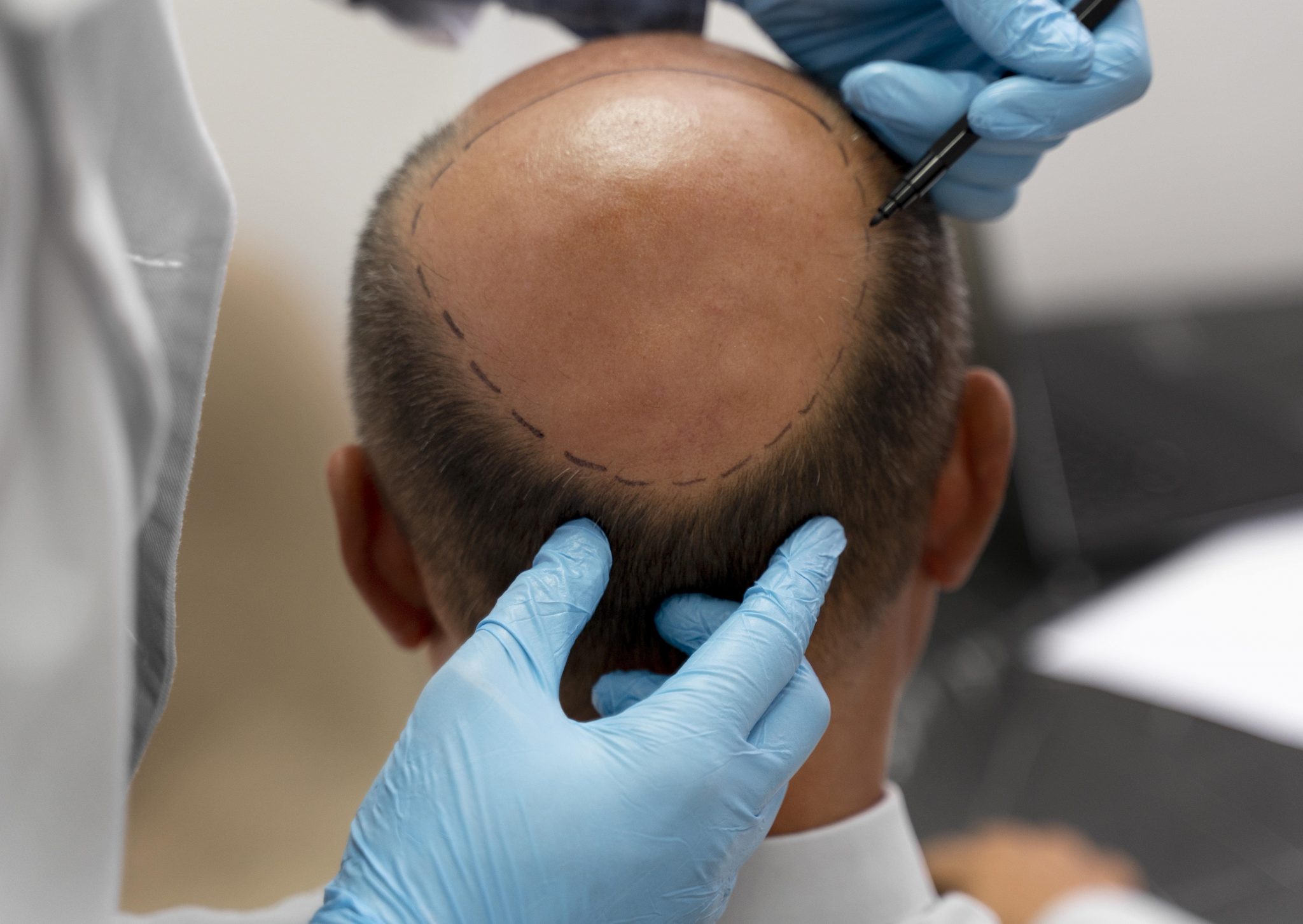 Best Hair Transplant in  Jaipur