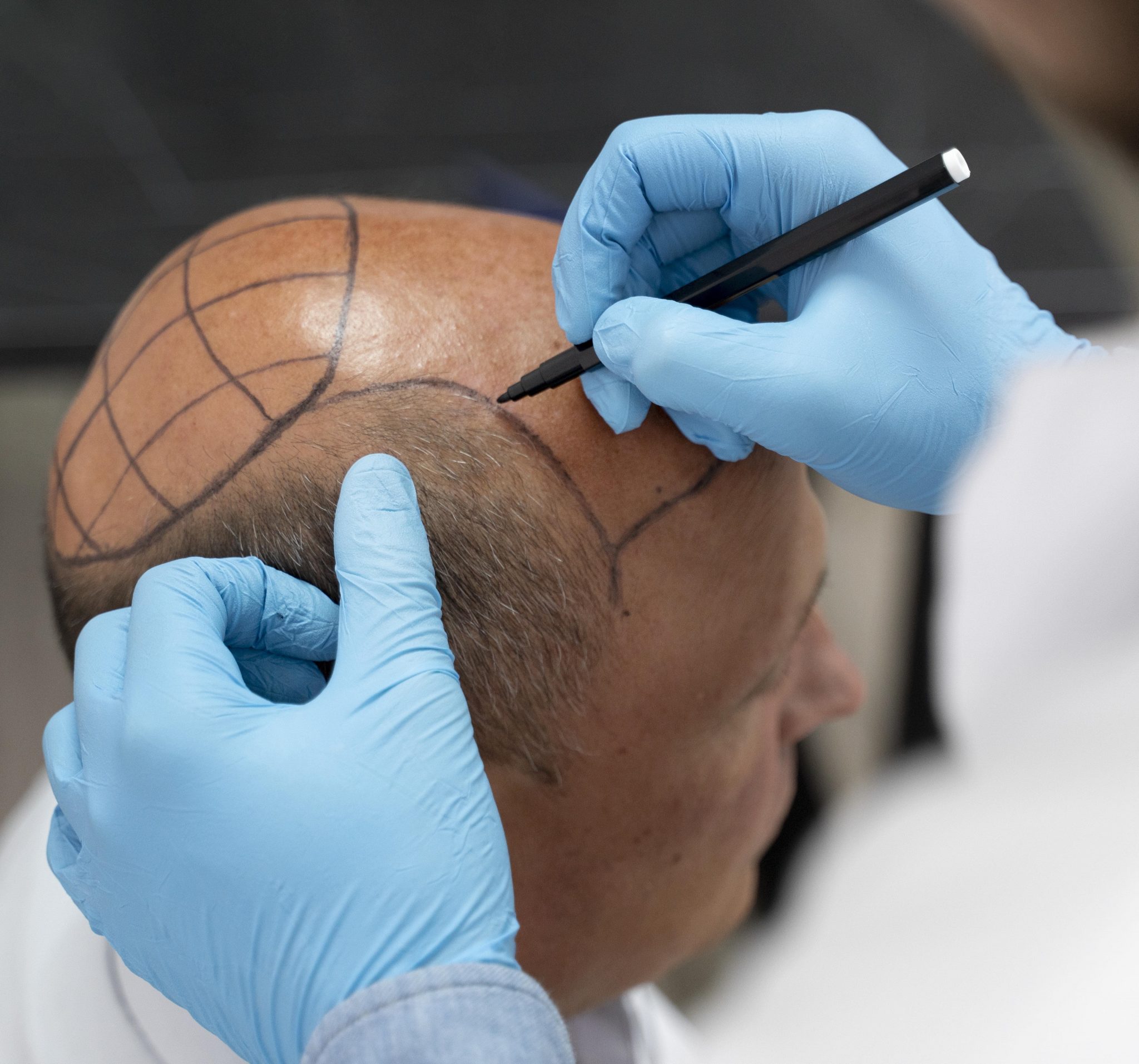 Best Hair Transplant in  Jaipur