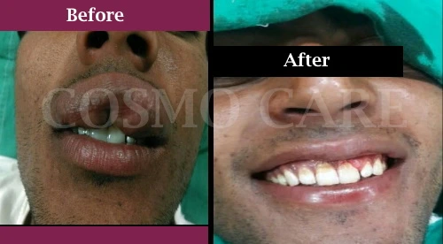 cosmetic surgery at cosmocarejaipur
