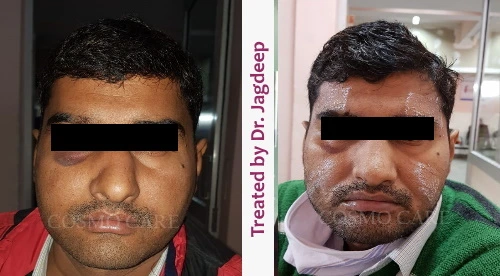 Nose Surgery done by dr jagdeep rao