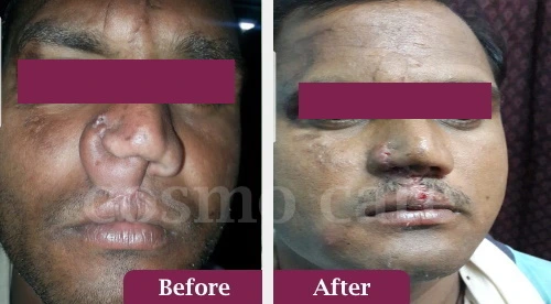 nose surgery at cosmocarejaipur